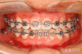 拔牙和牙齿矫正哪个更痛?到底有多痛?