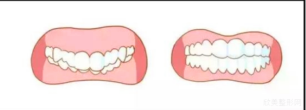 牙齿矫正等老了有什么影响我不知道，但我知道正畸对颜值的影响很大!