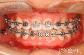 牙齿矫正的过程是怎样的?有几步?
