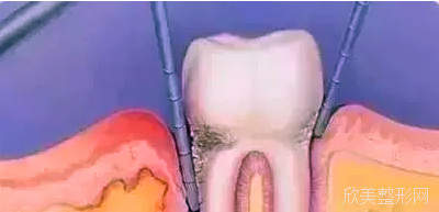 牙龈为什么会萎缩?造成牙龈萎缩的原因有哪些?