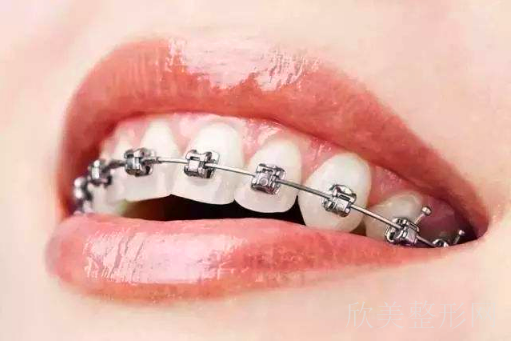 牙套的种类