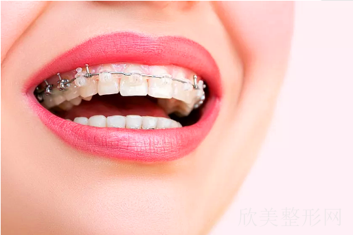 上海牙齿矫正多少钱?贵不贵?