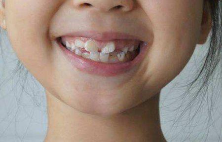 青少年牙齿矫正的后遗症是什么