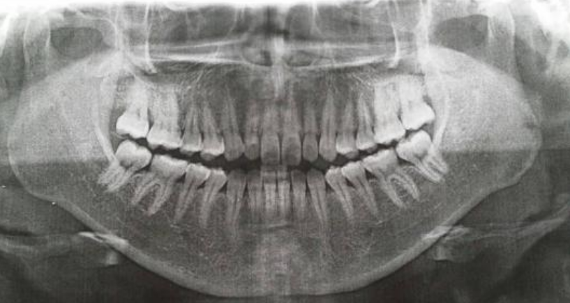 成人牙齿矫正后遗症和危害