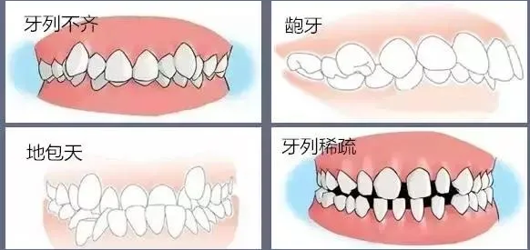 上海儿童牙齿矫正价格多少钱?孩子牙齿矫正有哪些注意事项？