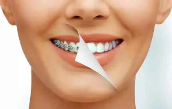 隐形牙齿矫正器优点是什么?需要注意哪些?