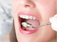 牙齿洗牙有助于牙齿健康吗?洗牙牙齿真能变白吗?