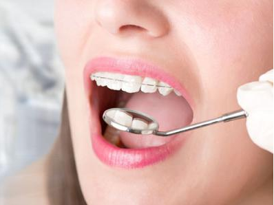 上海牙齿矫正需要多长时间?整牙一般需要多久?