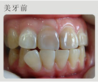 一颗牙齿歪了 可以只矫正这颗牙吗 欣美整形