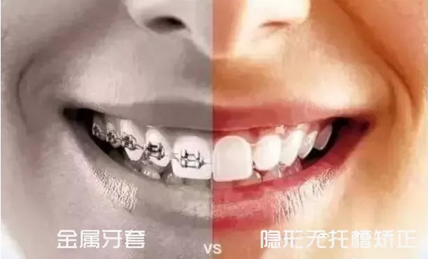 广州牙齿矫正的价格