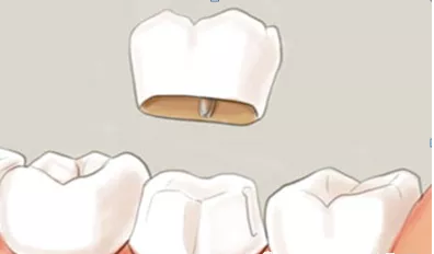 牙齿美白术 |五种美白牙齿方法大对比