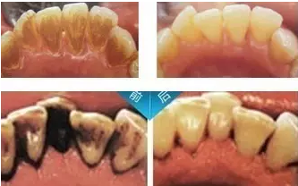 常见的几种牙齿美白方法有哪些?附赠效果对比图