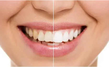 常见的几种牙齿美白方法有哪些?附赠效果对比图