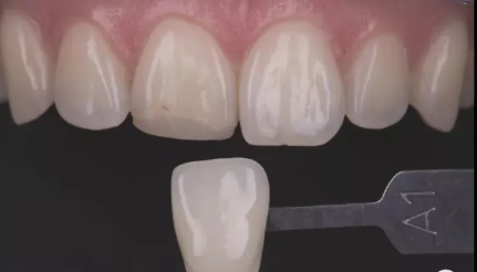 目前常见牙齿美白手段的比较和利弊，干货分享