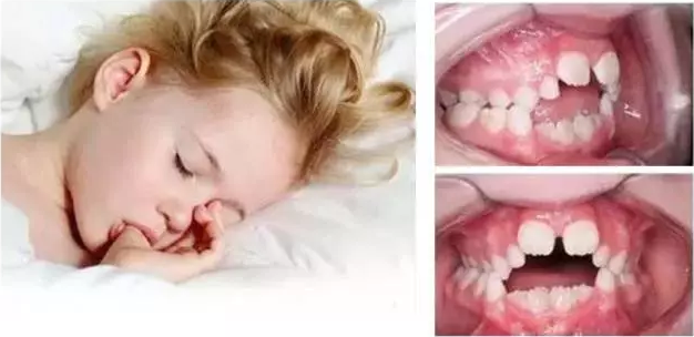 儿童牙齿矫正器管用吗