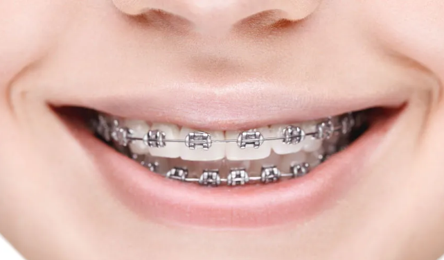 矫正牙齿一般需要多长时间?