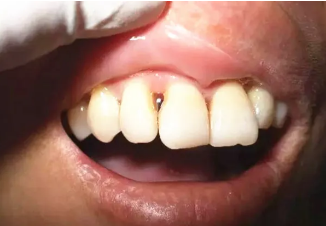 牙齿矫正后出现了黑三角，牙龈萎缩的情况还有救吗?