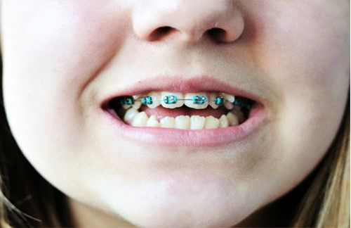 牙齿矫正对孩子以后有影响吗