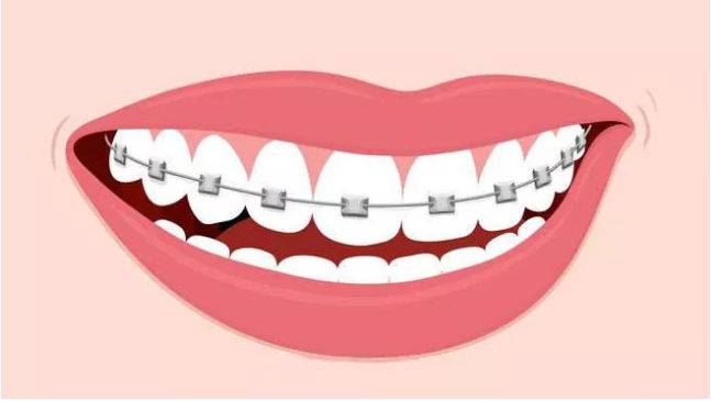 影响牙齿矫正价格的三大因素
