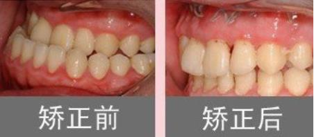 南京儿童医院牙齿矫正案例