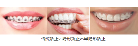 广州牙齿矫正需要多少钱