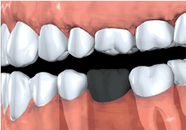 不良牙齿矫正带来的伤害都有哪些?
