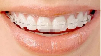 牙齿矫正有哪些种类，哪种好?隐形牙套好吗?
