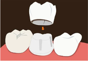 牙齿根管治疗费用一般多少钱一颗