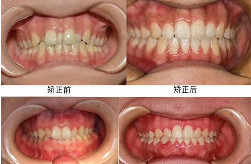 上海口腔医院牙齿矫正的费用