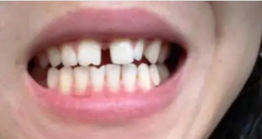 牙缝大，说话漏风，不做牙齿矫正还有别的办法吗?
