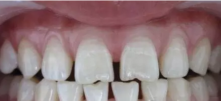 好好的一口牙，牙缝怎么变大的呢?