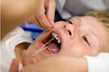 小孩牙齿长歪的矫正方法有哪些