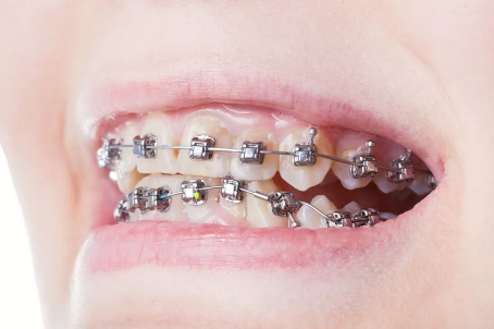 牙套那么多，该选哪一种?