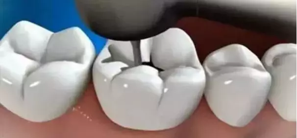 补牙的过程是什么样的