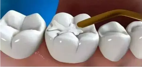 补牙的过程是什么样的