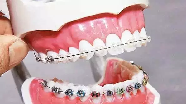 成人矫正牙齿选哪种牙套好？