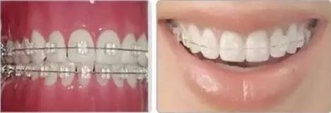 各种牙齿矫正技术，你喜欢哪一种呢?