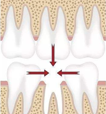 牙齿矫正的隐患有哪些