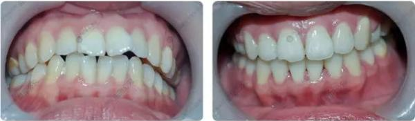 牙质不好的人可以矫正牙齿吗