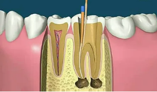 哪些牙齿需要做根管治疗?根管治疗多少钱?