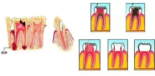 牙齿折断后要做根管治疗，这是咋回事?