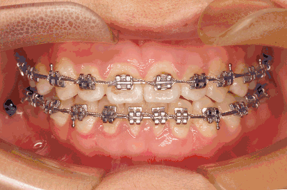牙齿矫正要一个月复诊一次吗?