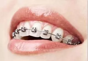 上海整牙价格#目前上海戴金属自锁牙套的价格大概是多少?