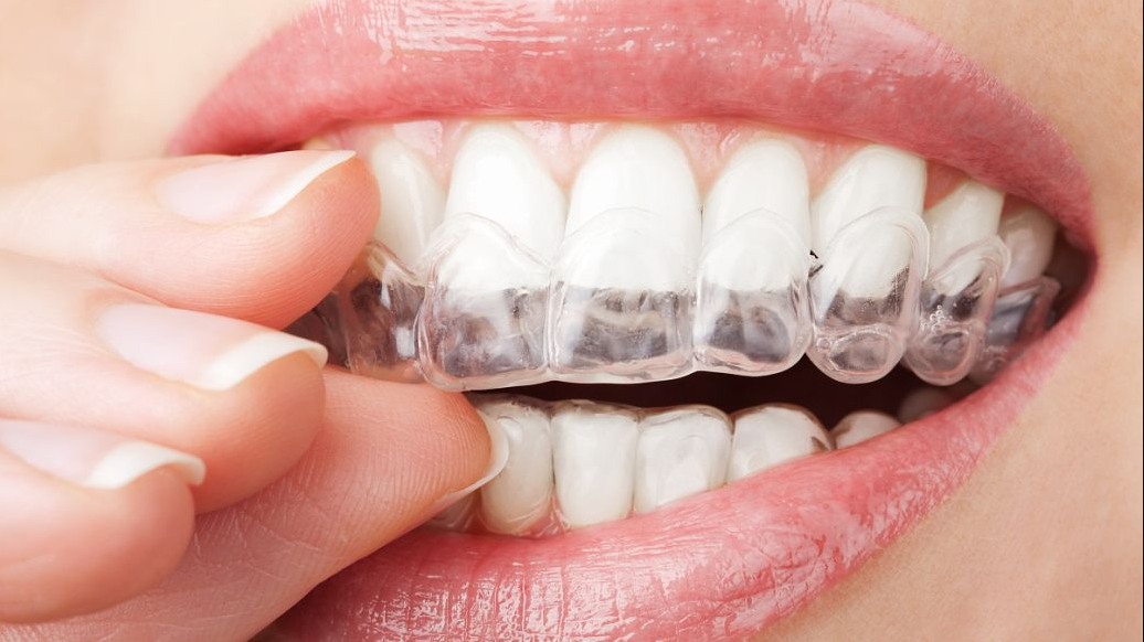 上海牙齿正畸费用的影响因素