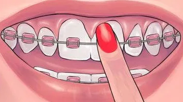 什么样的人适合做牙齿矫正?原来是这八种人!!
