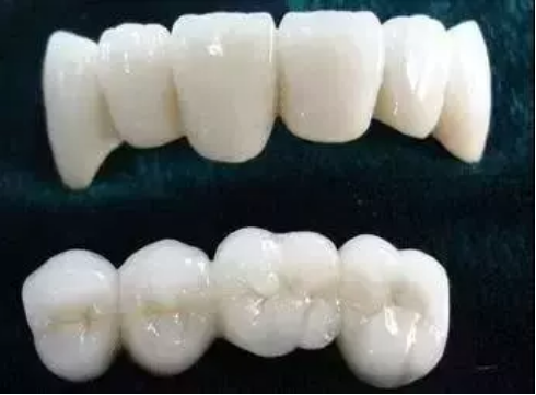 全瓷牙时间久了会有牙龈黑线吗?全瓷牙有哪些种类?