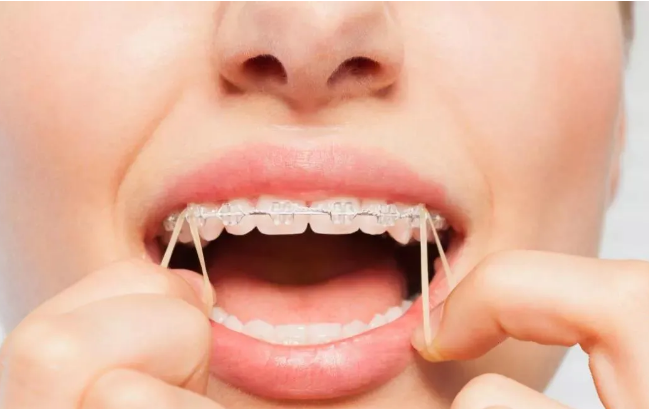 整牙挂皮筋有什么作用?