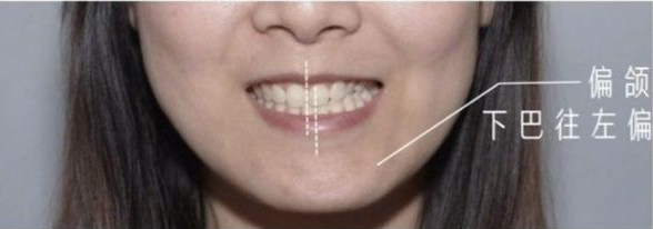骨性凸嘴和齿性凸嘴区别是什么?来看看下文~