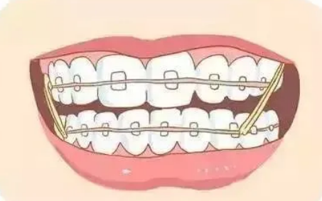牙齿矫正后，论正畸复诊的重要性!