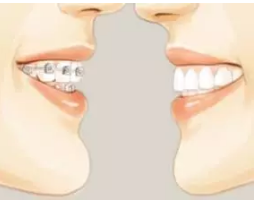 矫正时出现的牙齿松动，这个属于正常现象吗?